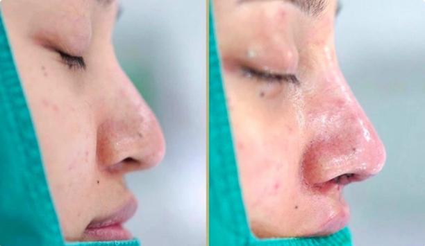 Biến chứng nặng sau nâng mũi phong thủy