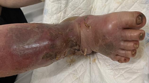 Cảnh báo lạm dụng thuốc Medrol gây suy tuyến thượng thận