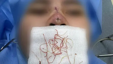 Những biến chứng khó lường khi căng chỉ nâng mũi